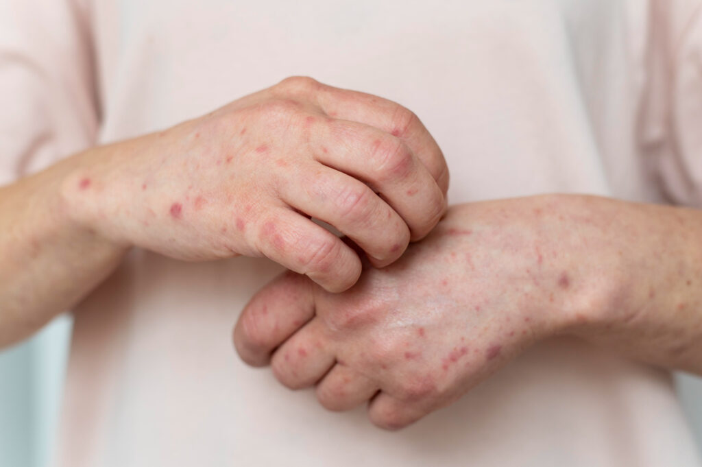 Mpox Is Back in 2025: What You Need to Know Before It’s Too Late