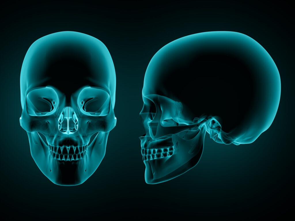 orbital bone fracture, orbital bone fracture recovery time, fractured orbital bone surgery