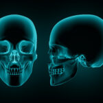 orbital bone fracture, orbital bone fracture recovery time, fractured orbital bone surgery